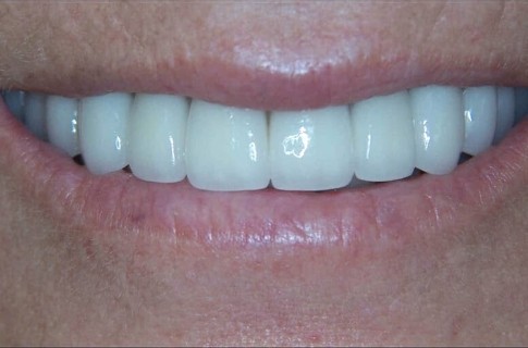 Bright healthy smile after cosmetic dentistry