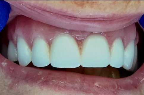 Flawless healthy smile after cosmetic dentistry