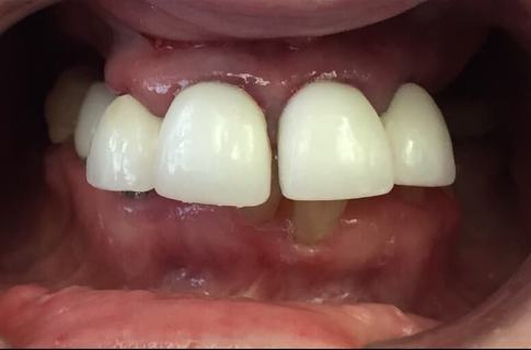 Front teeth larger than surrounding teeth before dental treatment