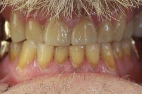 Healthy smile after restorative dentistry