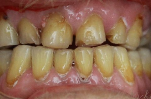 Severely decayed and damaged teeth before restorative dentistry