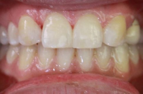 Healthy flawlessly aligned smile after cosmetic dentistry
