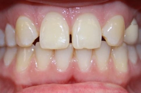 Gaps between teeth before cosmetic dentistry