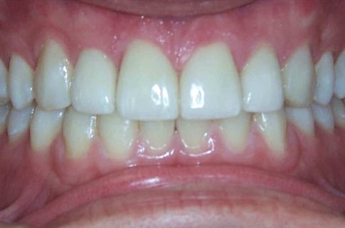 Closed gap between front teeth after cosmetic dentistry