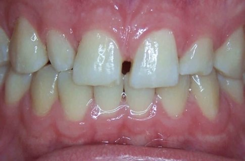 Large gap between front two teeth