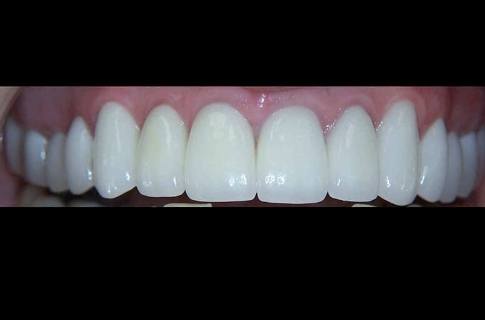 Healthy beautiful smile after cosmetic dentistry