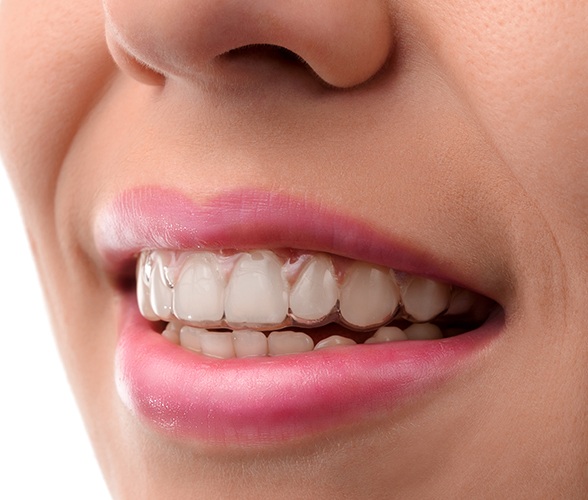 Closeup of smile with clear aligners in place
