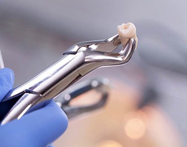 A dentist’s dental forceps holding an extracted tooth