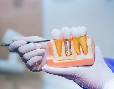 A dentist points to a mouth mold with a single dental implant in Wauwatosa