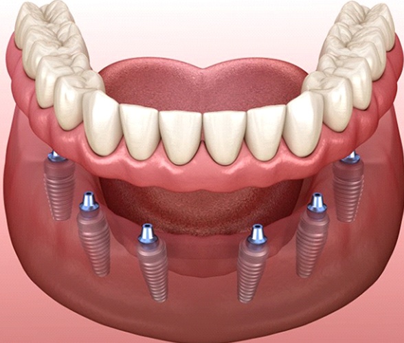 model of how implant dentures in Wauwatosa work