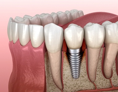 Dental implant in Wauwatosa