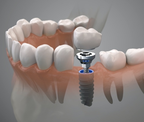 Animated smile during dental implant supported replacement tooth placement