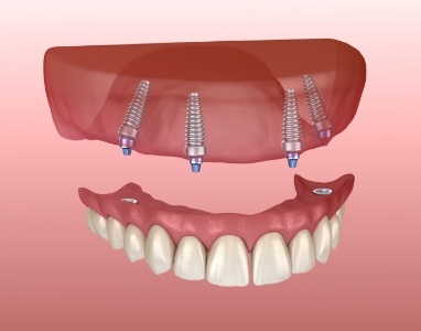 Animated smile during all on four dental implant placment