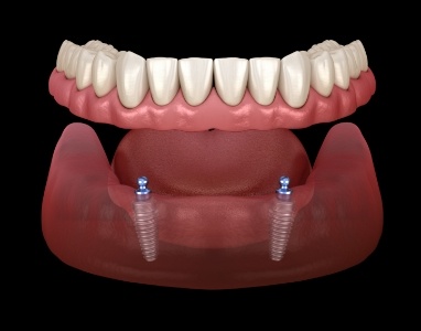 Animated smile during mini dental implants smile restoration