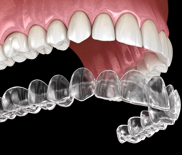 A digital image of an Invisalign aligner being used to correct a bite misalignment in Wauwatosa