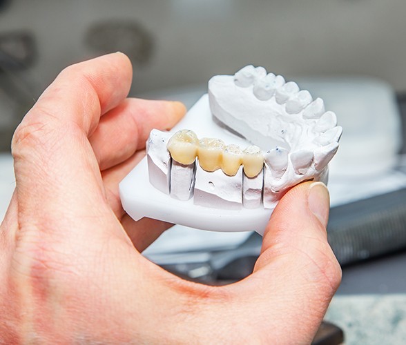 Model smile with dental bridge restoration
