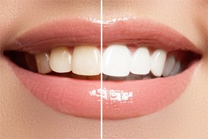 a before and after shot of a patient’s teeth