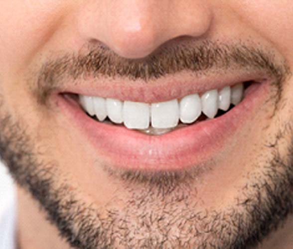Before and after image of teeth whitening in Wauwatosa